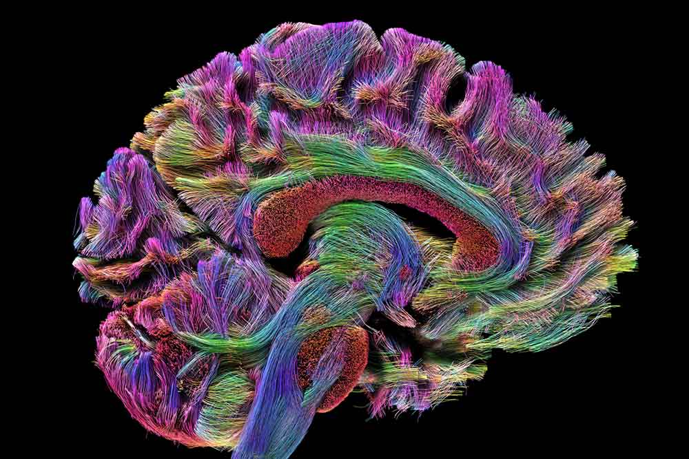 A colorful brain scan.