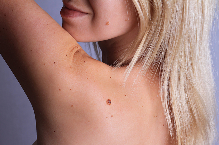 6 Melanoma Symptoms to Show Your Doctor Now - Melanoma Monday