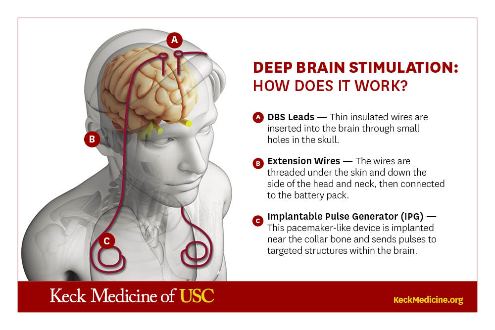 Deep-Brain Stimulation for Parkinson's Disease