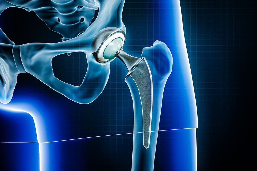 A graphic design of an artificial hip