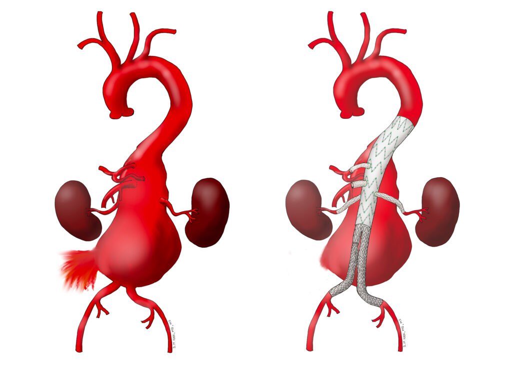 Preventing Spinal Cord Stroke Following Endovascular Thoracoabdominal Aortic Aneurysm Repair