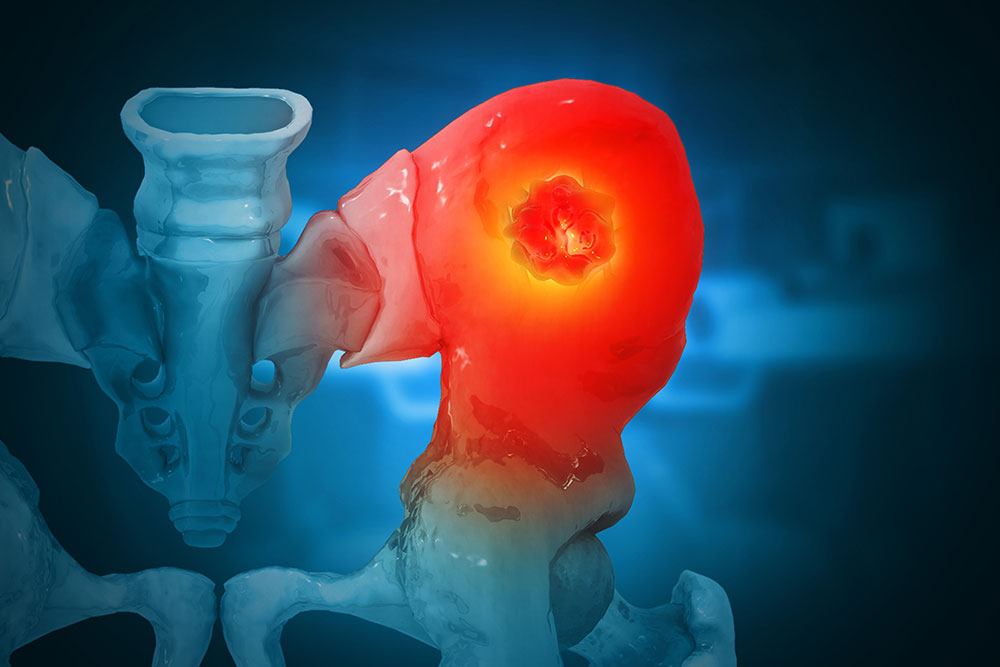Imaging showing cancer in the hip bone as a result of bone metastasis.