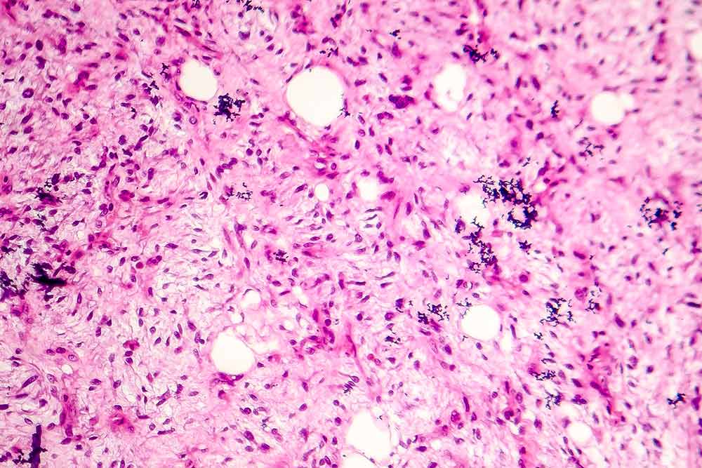 Image of a liposarcoma, soft tissue sarcoma, under a microscope.