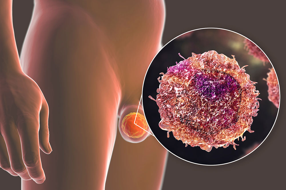 Can Early Metastatic Testicular Cancer Be Cured with Surgery Alone? 