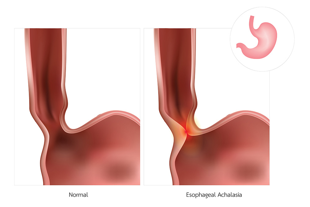 Minimally Invasive Procedure Restores Achalasia Patient’s Ability to Keep Food Down