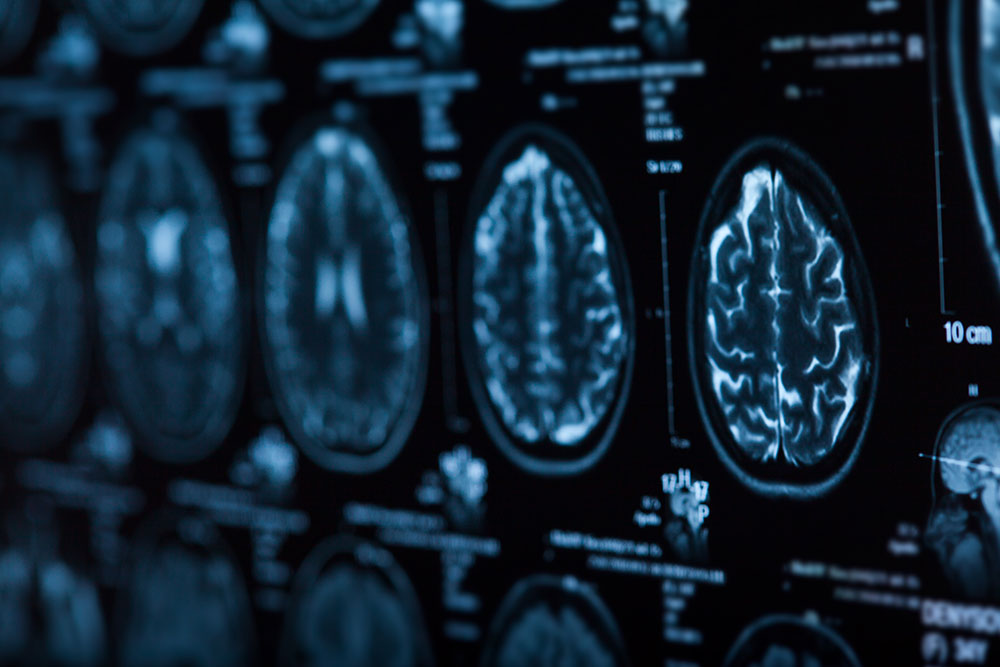 Advancing hope for patients with neurological conditions