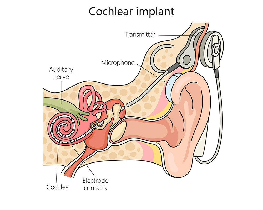 Illustration of a cochlear implant