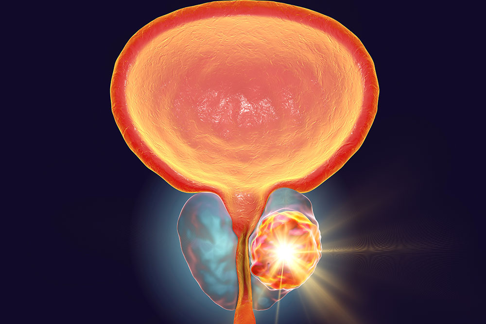 Prostate Cancer: Advances in Preserving the Prostate Gland 