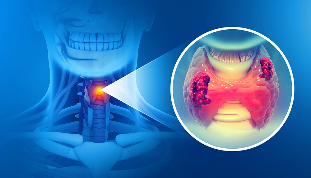 Thyroid Cancer: What Are the Latest Advances in Treatment?