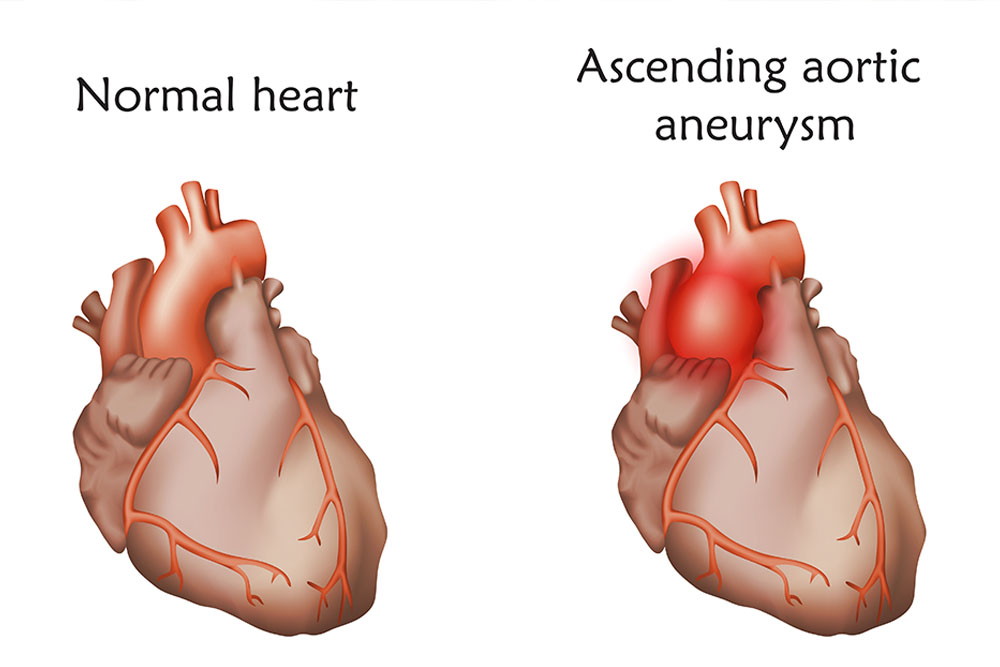 Illustration of an ascending aortic aneurysm.