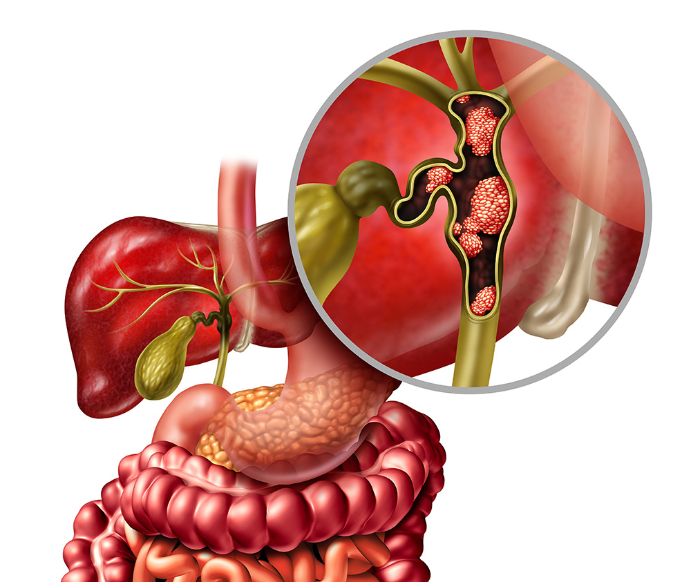 What Are the Latest Advances in Cholangiocarcinoma Treatment?